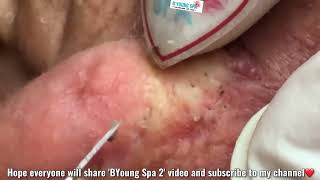 Squeeze blackheads perennial 50 years around the ear acne popping newvideo