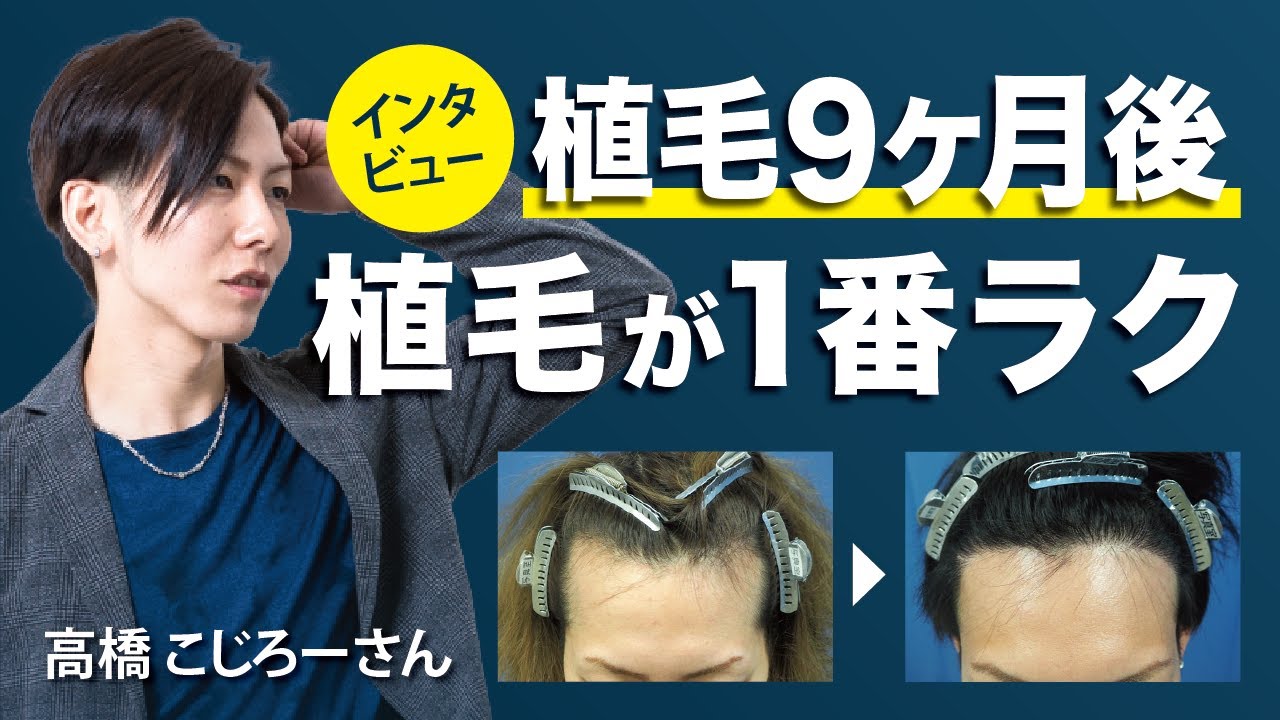 植毛を芸能人が解説 アイランドタワークリニックがテレビで紹介されました Youtube