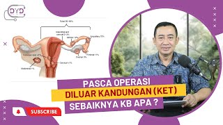 Ask Me - Tanya Dr. Yan | Pasca Operasi Diluar Kandungan (KET) Sebaiknya KB Apa ?