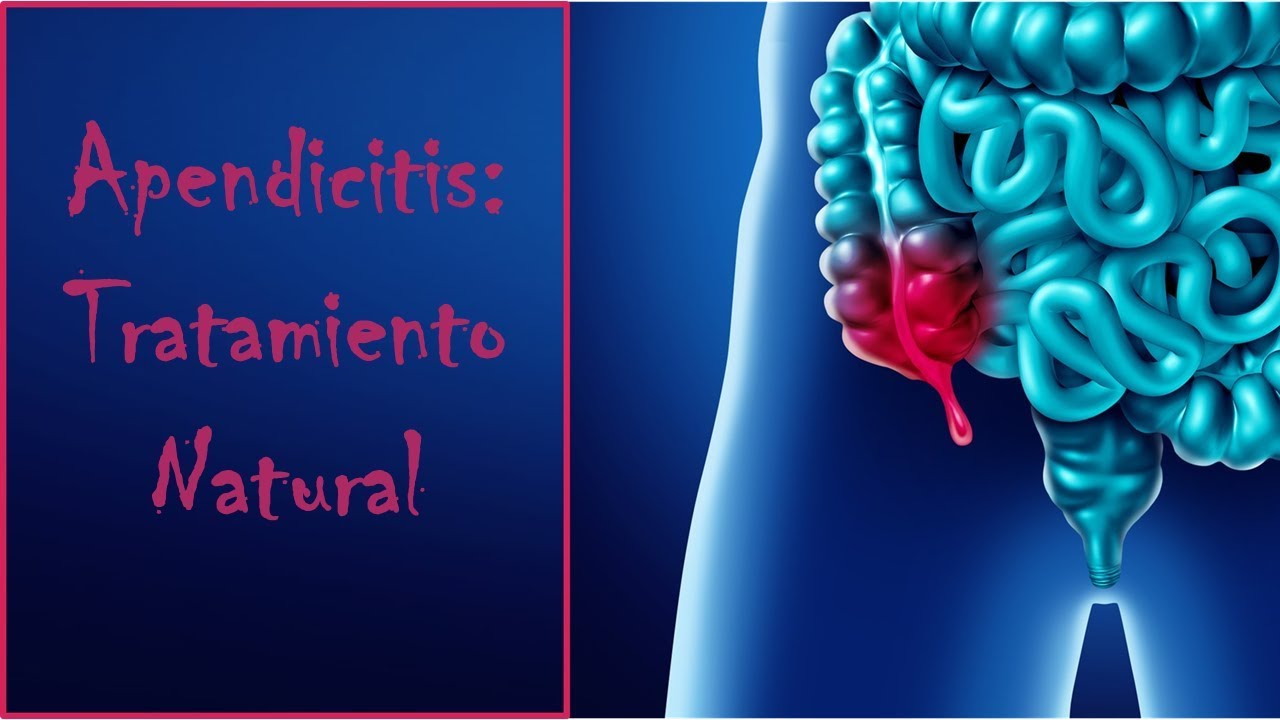 Apendicitis: Tratamiento natural por Nely Helena Acosta Carrillo - YouTube