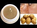 DIY Potato Cream | Removes Dark Spots, Pigmentation & Uneven Skin Tone | Skin Lightening Treatment