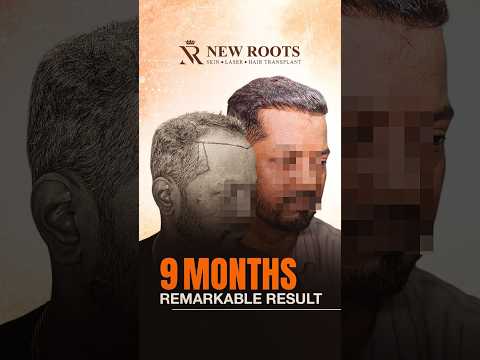 Grade 5 Baldness, 5500 Grafts, 9 Months Result | Hair Transplant in Mumbai #hairtransplant #shorts