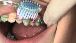 How to brush with braces - Dr. Powell's office demonstrates!