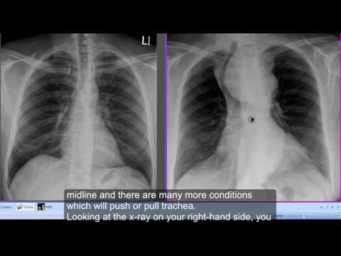 Video: Retrosternal Chest Pain: Definisi, Penyebab, Dan Perawatan