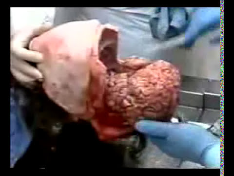 Autopsy - YouTube