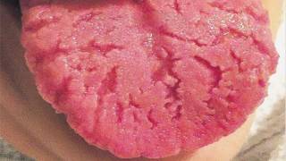 Geographic Tongue Picturesimages In Men And Women