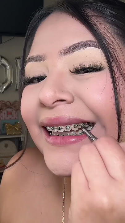 Braces 😬💕#braces #bracescolors #bracesupdate