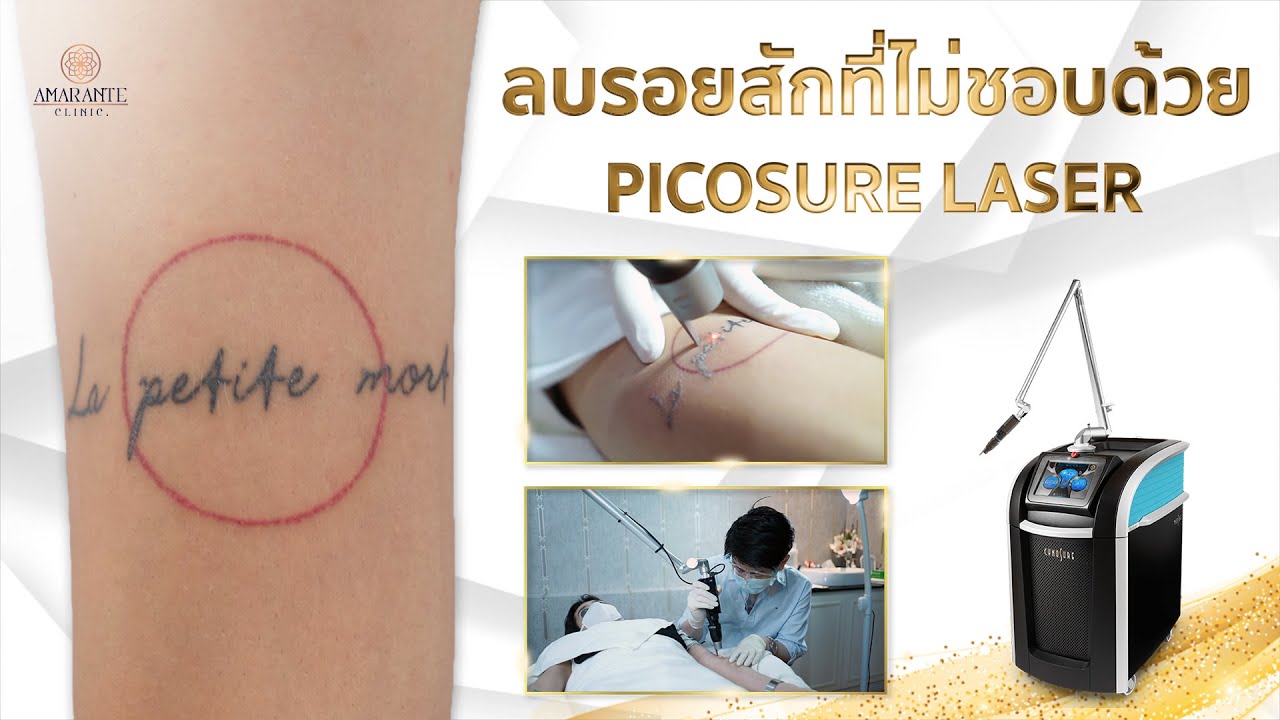 pico laser ที่ไหนดี รีวิวปัญหาฝ้ากระ คนไข้จริงเยอะที่สุด เลเซอร์โดยอาจารย์แพทย์