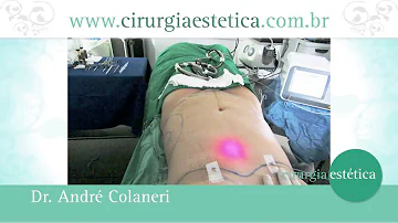 Como é realizado a lipo a laser?