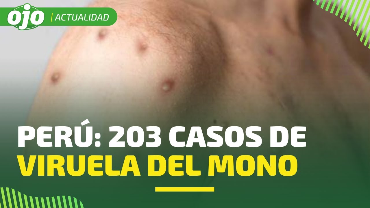 Cuanto tiempo dura la viruela del mono