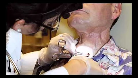 Placing the Provox XtraFlange - reducing periprosthetic leakage - for clinicians