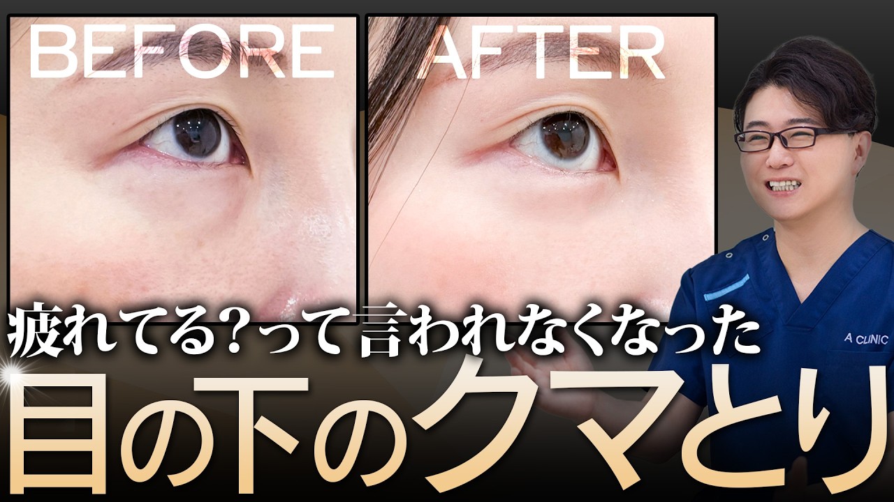 【目の下のクマとり】もう「疲れてる？」って言われない明るい目元を手に入れるまでの経過を大公開！