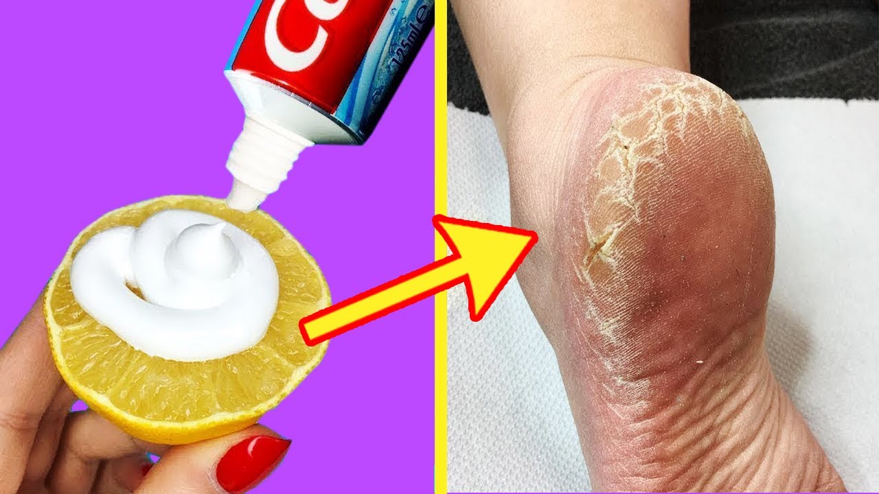 Remove Cracked Heels and Get Beautiful Feet - Magical Cracked Heels