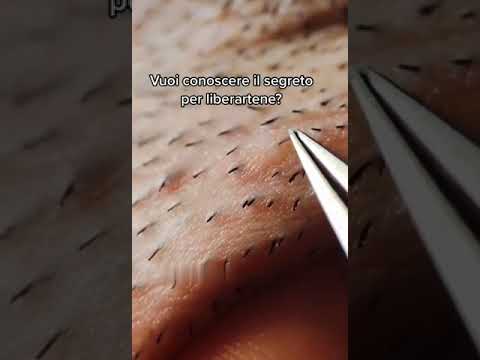 Video: 3 modi per prevenire i peli incarniti dopo la rasatura