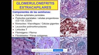 glomerulonefritis extracapilares