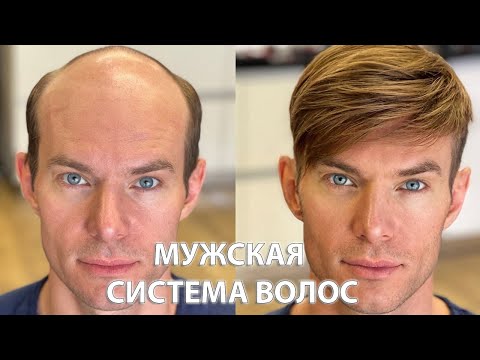 Алопеция у мужчин- Накладка из волос- До и после