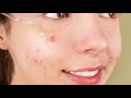 Extreme Close Up Pimple Pores Itching |Pores