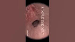 Cara melihat kedalaman rahim! 😱 #kesehatanwanita #pemeriksaanrahim #hiteroskopi #tipspromil