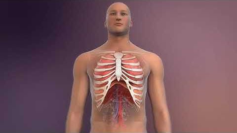 Hybrid Ablation For Atrial Fibrillation: Treating AFib