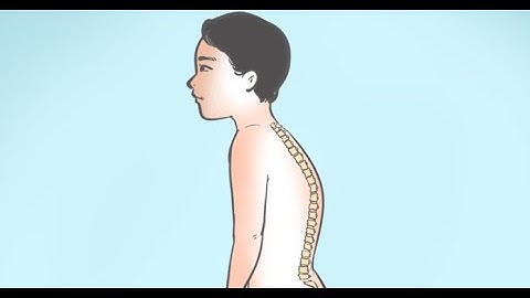 HCDC | Phòng ngừa cong vẹo cột sống trong trường học