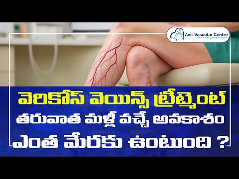 Can Treated Veins Come Back? | Avis Hospitals Jubilee hills