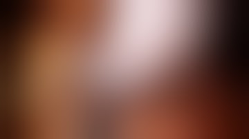 Robotic Retroperitoneal Left Partial Nephrectomy - UROPS - Urologue Nancy