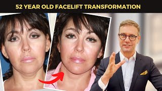 15 YEARS YOUNGER? 52 Year Old's INCREDIBLE Facelift Surgery Before and After