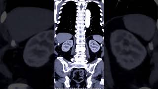 Abdominal Aortic Aneurysm 🧑‍⚕️#shorts #aorta