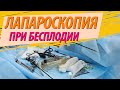 Лапароскопия при бесплодии. ЖЕНСКОЕ БЕСПЛОДИЕ💊