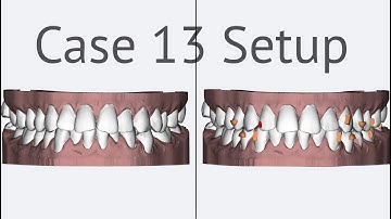 Maestro 3D aligners virtual setup: case 13, lower teeth distalization