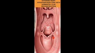 PARTIAL LARYNGECTOMY -EXTENDED HYPOPHARYNGECTOMY WITH SUBMENTAL FLAP RECONSTRUCTION