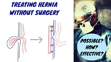 Treating Hernia Without Surgery