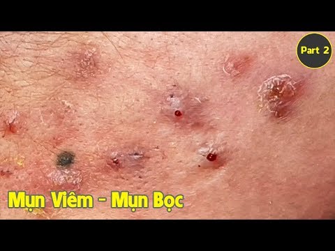 Video Điều trị mụn ẩn - mụn viêm - mụn bọc hiệu quả nhất... - youtube