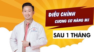 Cắt mí và điều chỉnh lại cân cơ nâng mi sau 1 tháng | Bác Sỹ Tuấn Dương