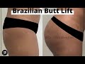 Brazilian Butt Lift Before And After Dr Shilpi Bhadani