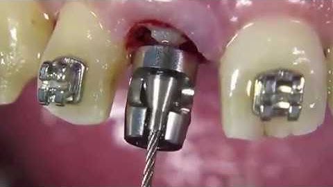 Benex Extraction System  For root removal