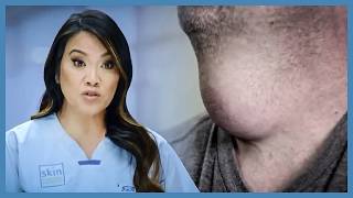 Dr Lee Removes A Neck Mass Other Doctors Have Feared Dr Pimple Popper