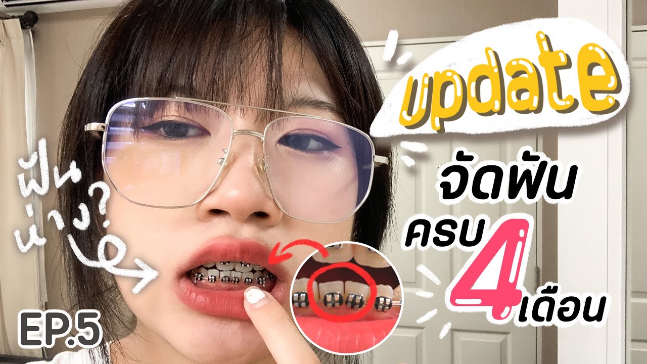 🦷UPDATE🦷 จัดฟันครบ4เดือน!! กรอฟันเพิ่ม?! ฟันห่าง:0 EP.5 (มีต่อฮัฟฟ) | SOMz
