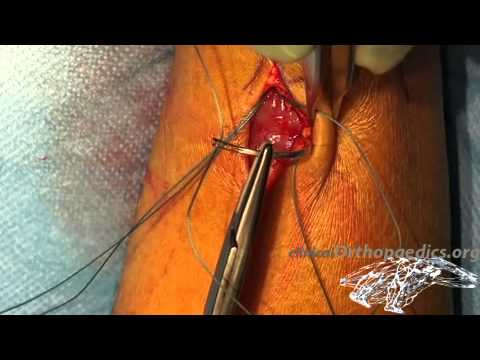 Mini-invasive surgical repair of a ruptured Achilles ...