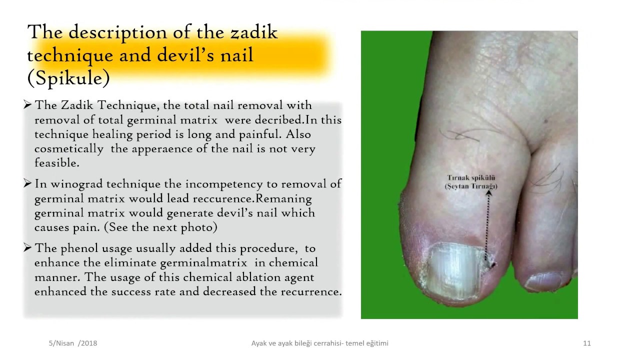 Ingrown Nail ( English Edition )