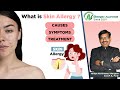 What is skin allergy  causes symptoms  treatment  causes for skin allergy dr bhargavs