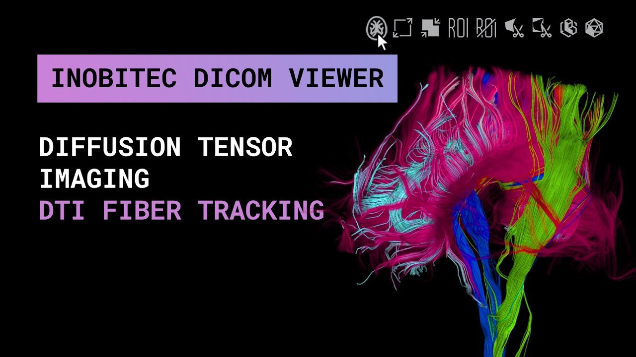 DTI fiber tracking in Inobitec DICOM Viewer Pro