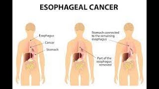 CPT code for Total Esophagectomy - simplify medical coding