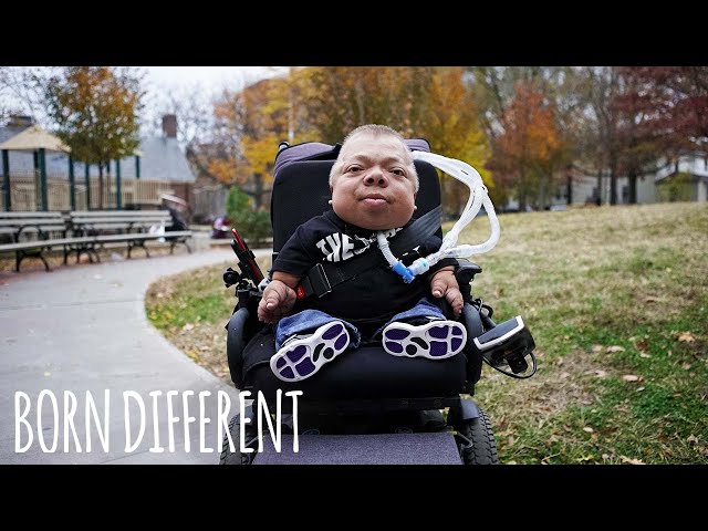 I'm The Oldest Person In The World With My Condition | BORN DIFFERENT class=