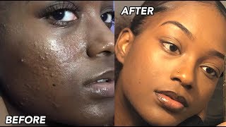 HOW I CLEARED MY SKIN FT. DIY Natural Face Wash + Tips!