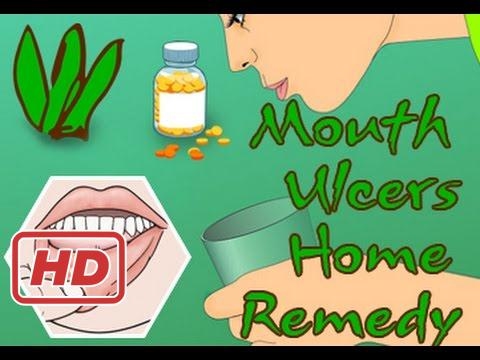 how to treat mouth ulcers at homedd 