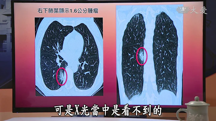 【健康報你知】20180807 - 早篩治癌不肺力 - 天天要聞