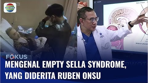 Ruben Onsu Sudah Kena, Simak Gejala dan Penyebab Empty Sella Syndrome! | Fokus
