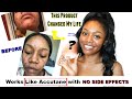 Natural Cystic Acne Cure in 2 Weeks! + My Acne Journey