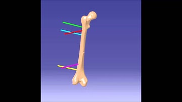 Fixation Animation - Mitkovic External Fixator - Femur